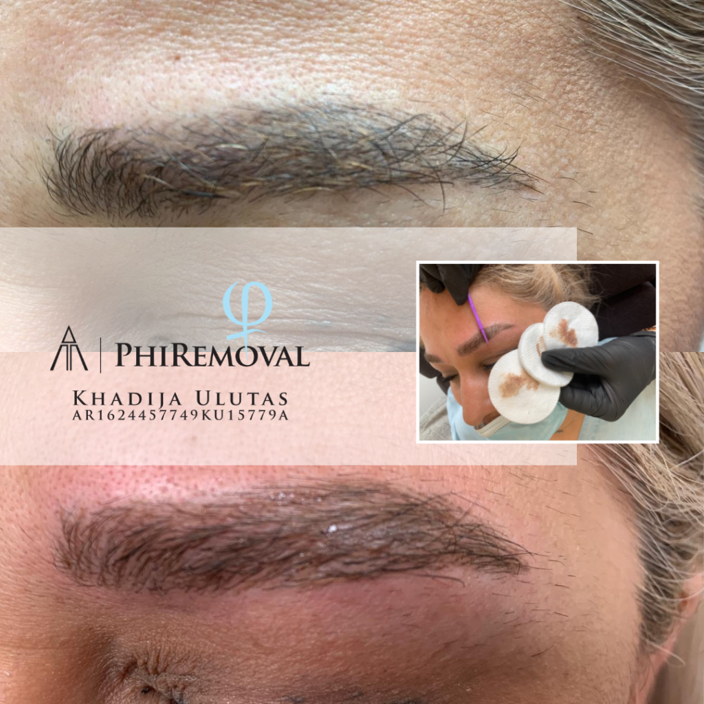 Phi Removal SK Esthetic Almere